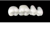 Cod.EXLOWER LEFT : 15x  posterior hollow wax veneers-bridges, X-LARGE, (34-37), with precarved occlusion to Cod.EXUPPER LEFT, and compatible to Cod.SXLOWER LEFT  (solid), (34-37)